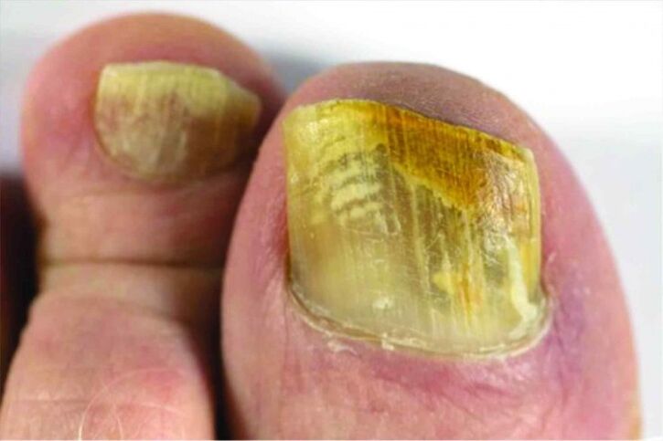 Gefühl des Nagels am Bein