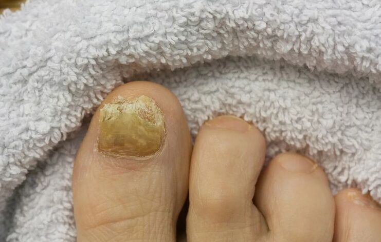 Nagelpilz